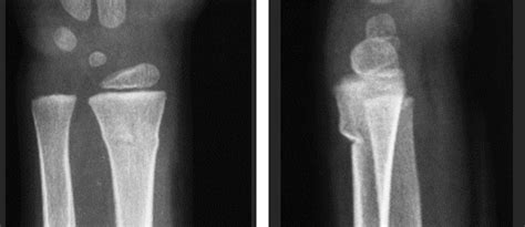 Child Bone Fractures Common Paediatric Injuries Singapore