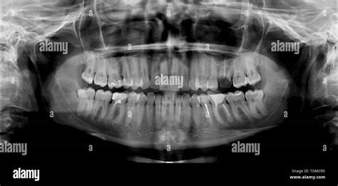 Mandible X Ray Black And White Stock Photos And Images Alamy