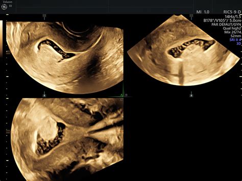 Ultrasound Fibroids Empowered Womens Health