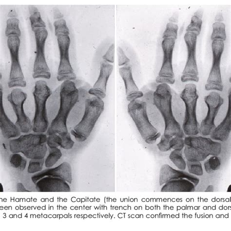 Postaxial Polydactyly In Both Hands White Arrows Download Scientific Diagram