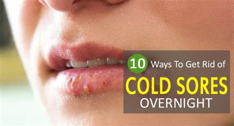 How To Get Rid Of Cold Sores 10 Effective Ways To Try Remedies Lore