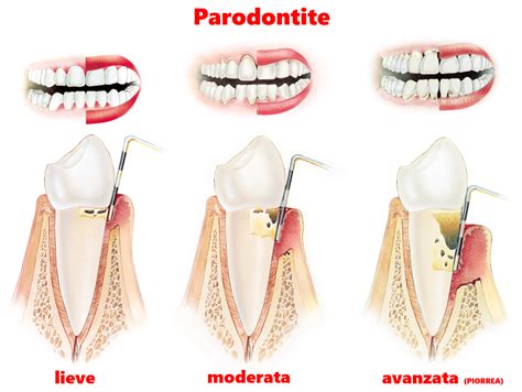 Parodontologia Studio Dentistico Putero