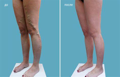 Диета для тромбоза глубоких вен ᐉ Тромбофлебит (тромбоз) вен нижних конечностей: лечение в Киеве ⏩ ᐉ Тромбофлебит (тромбоз) вен нижних конечностей: лечение в Киеве ⏩ Диета для тромбоза глубоких вен