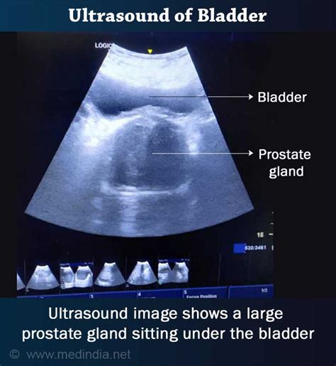 Renal Bladder Ultrasound