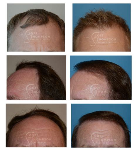 Everything You Need To Know About Hair Transplants Hair Transplant