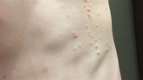 Molluscum Contagiosum Infection Bumps Rash On Skin Of