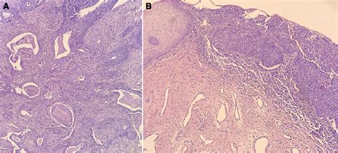 Ab Hande Biopsy Of A Grade 2 Invasive Squamous Cell Carcinoma