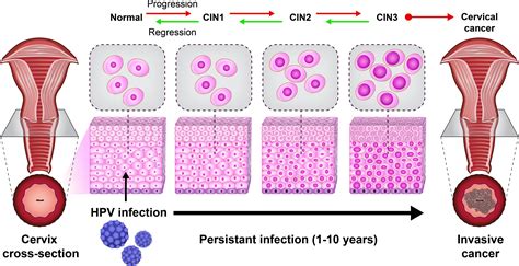 Natural History Of Hpv Infection And Stage Wise Progression Of Cervical
