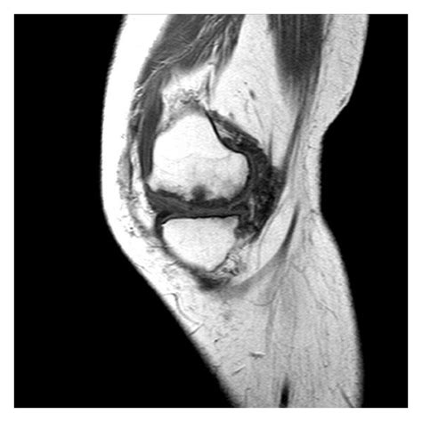 Mri T1 Sagittal View Of The Left Knee Download Scientific Diagram
