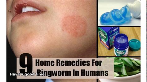 Home Remedies For Ringworm Top 5 Diy