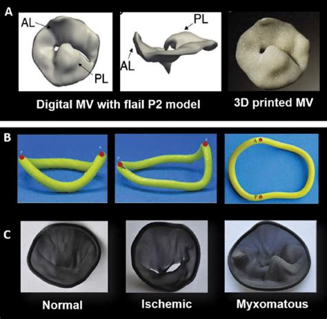 Echo Based Patient Specific Mitral Valve Modeling A Digital And 3d Download Scientific