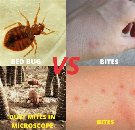 Mite Bites Vs Bed Bug Bites