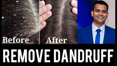 Dandruff Treatment Causes And Home Remedies Youtube