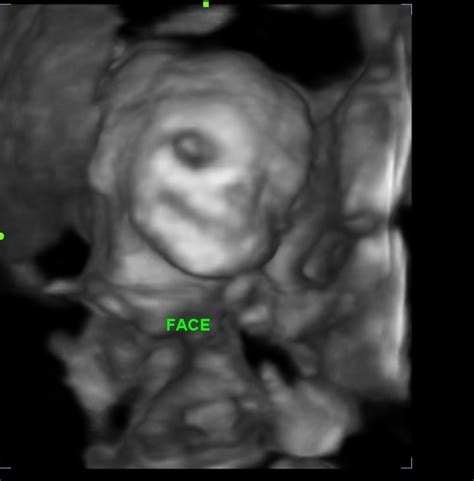 You will need to get a referral from your doctor or midwife for a dating scan. BANGALORE ULTRASOUND BLOG: 3D/4D scan for pregnancy