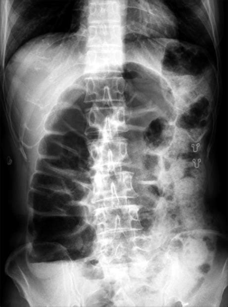 Figure 1report Of An Unusual Case With Severe Fecal Impaction