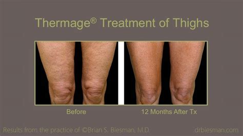 Thermage Before And After Gallery Brian Biesman Md Nashville Tn