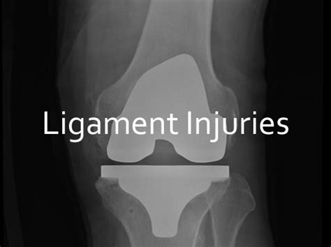 Ligament Injury Causes Symptoms Treatment Canberra