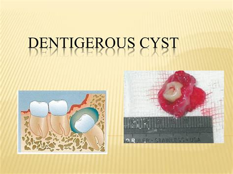 Solution Understanding Dentigerous Cysts Causes Symptoms And
