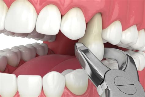 Same Day Dental Restoration Tooth Extractions And Implants On The