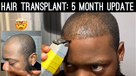 An appropriate name for such a difficult place to completely fill in with a hair transplant. Hair Transplant Journey | 5 Month Update | FAQ's | Haircut ...