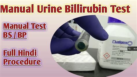 Urine Bilirubin Test Bile Pigment Test In Urine Urine Bilirubin