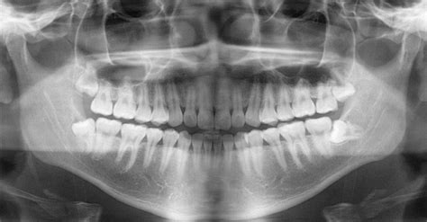 Dental Braces 101 Part 2 X Rays And Impressions Archwired
