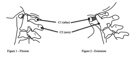 And 2 Line Diagram Of The Atlas C1 And Axis C2 Vertebrae Showing