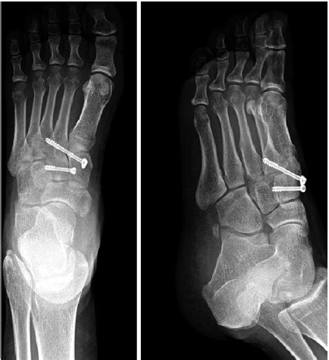 Diagnosis of a lisfranc fracture requires a thorough. Closed reduction with internal fixation for a subtle ...