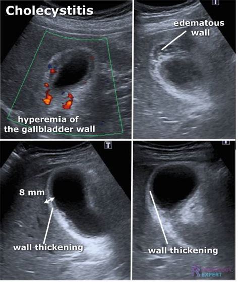 Abdominal Ultrasound