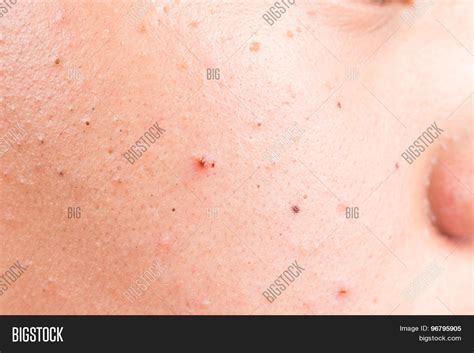 Close Pimple Image And Photo Free Trial Bigstock