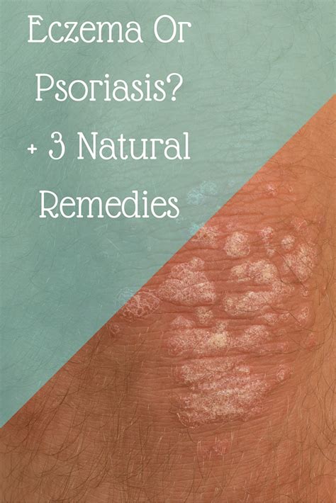 Is It Eczema Or Psoriasis Natural Treatments Brea Getting Fit
