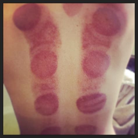 What You Need To Know About Cupping Therapy Hubpages