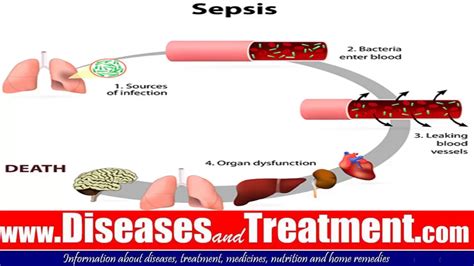 •a condition caused by an overwhelming immune response to an infection in the body. Sepsis ( Blood Poisoning ) septicemia : : Causes, Symptoms ...