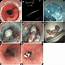 Submucosal Tunneling And Endoscopic Resection Of Subepithelial Tumors 