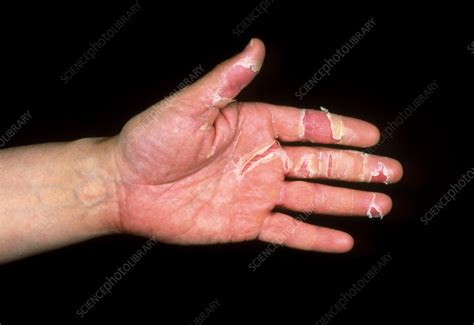 Dermatitis On A Mans Hand Due To Stress Stock Image M1400248