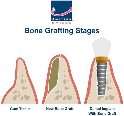 Bone Grafting For Dental Implants An Essential Guide