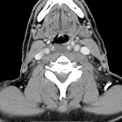 Retropharyngeal Abscess Radiology Case