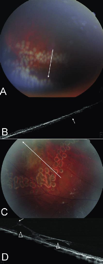 Retinal Thinning In The Lattice Degeneration A And B A Color Photo