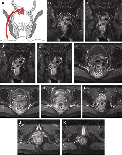 Magnetic Resonance Imaging Of Perianal Fistulas Magnetic Resonance Imaging Clinics