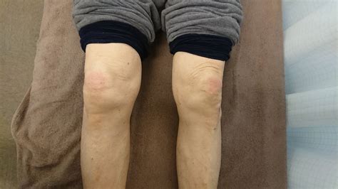 腰椎辷り症の改善例【大阪 平野区 生野区 腰椎辷り症 腰痛 ...