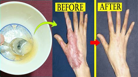 How To Remove Burn Marks And Scars From Skin Best Home Remedy For