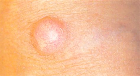 Epidermal Cyst Medical Pictures Info Health Definitions Photos