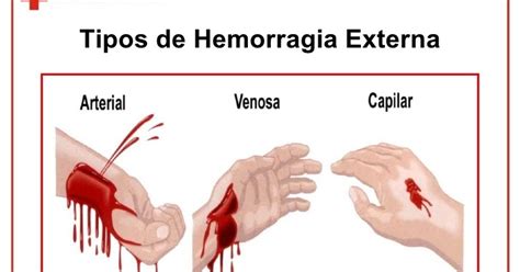 PRIMEROS AUXILIOS HEMORRAGIAS