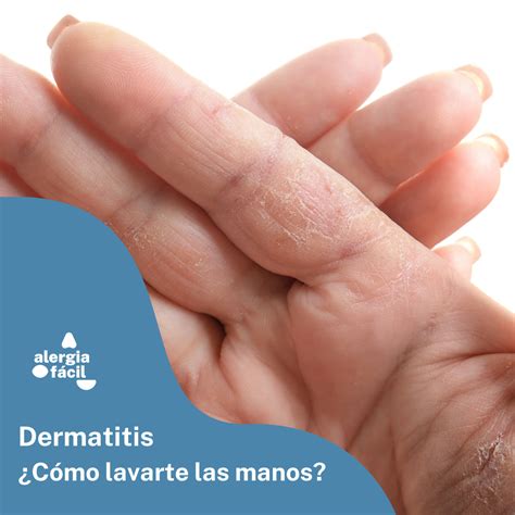 Dermatitis De Manos Alergiafacil