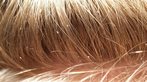 Head Lice What You Need To Know Knoxville Institute Of