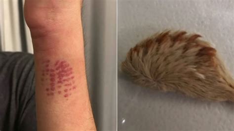 Florida Teen Lands In Emergency Room After Encounter With Venomous Caterpillar Abc7 Los Angeles