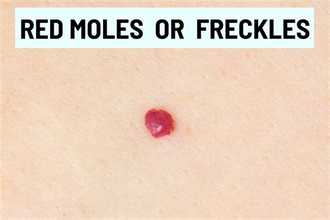 Red Moles Or Freckles What Are They And Should You Worry