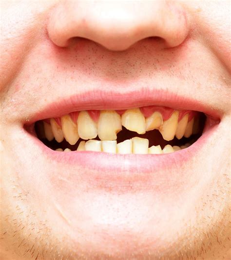 Broken Teeth | Square Mile Dental Centre | London Dental Clinic