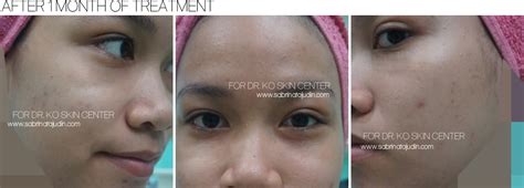 Kota bharu is the state capital of kelantan, on the east coast of peninsular malaysia. My Dr. Ko Skin Center Experience for my Acne Problem ...