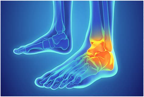 Ankle Sprain Treatment Orthofootmd